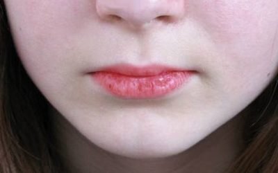 Tips for Moisturizing Dry Lips During Cold Weather