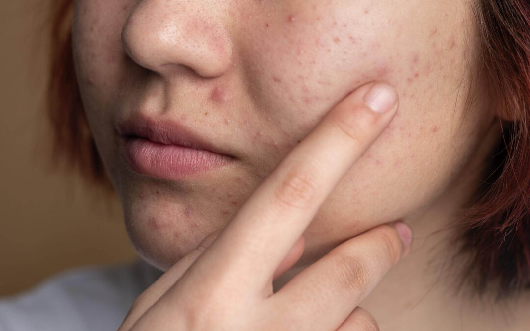 Tips Mengatasi Kulit Berminyak dan Komedo dengan Skincare yang Sesuai